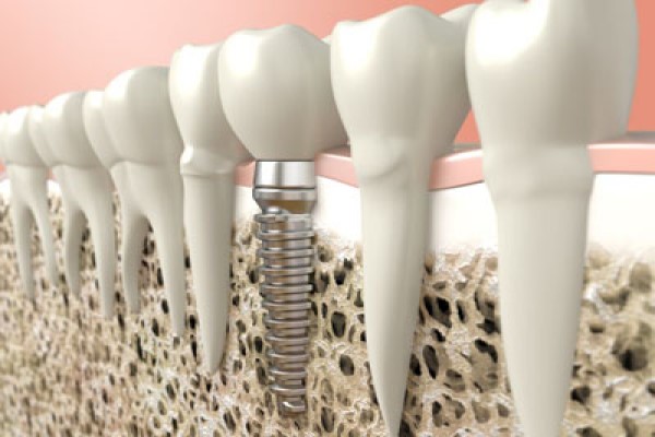 Dental Implant Bone Graft  Bone Grafting for Dental Implant