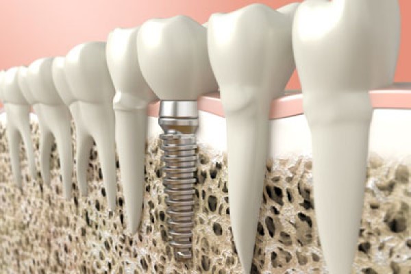 Bone Graft For Dental Implants Red Bluff, CA