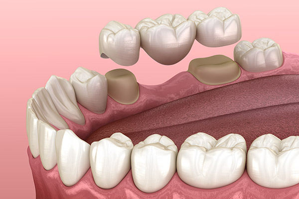 Dental Bridge Options for Replacing Missing Teeth from Randal S. Elloway DDS, Inc in Red Bluff, CA