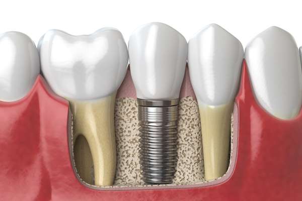 Dental Implants for Replacing Missing Teeth from Randal S. Elloway DDS, Inc in Red Bluff, CA