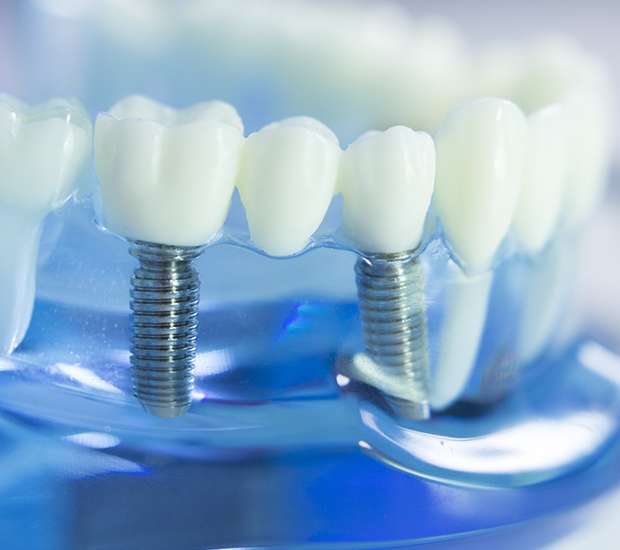 Red Bluff Dental Implants