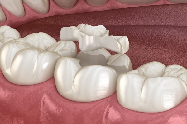 What Is A Dental Inlay And How Is It Used?