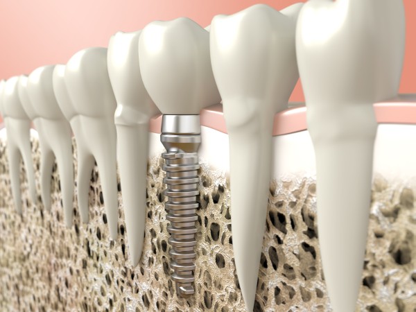 How Dental Implants Benefit More Than Just Your Appearance