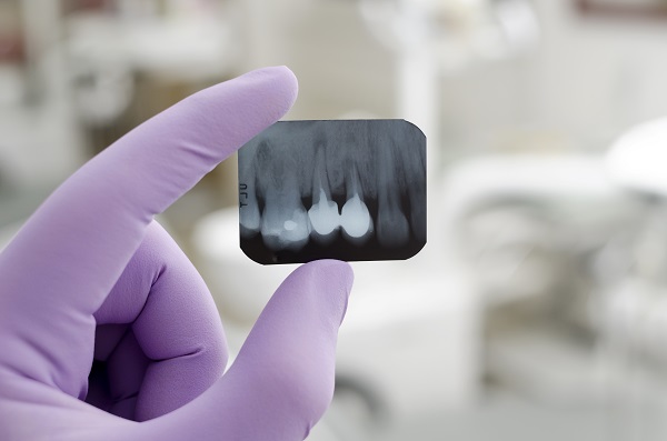 How Digital X Rays Can Help Your Dental Exam