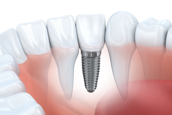 Implant Dentist Red Bluff, CA