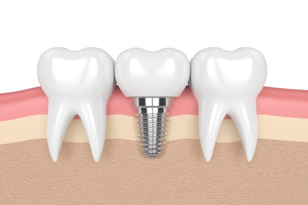 Implant Dentist Red Bluff, CA