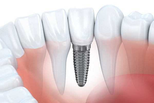 An Implant is a New Tooth Root Option for Replacing a Missing Tooth  from Randal S. Elloway DDS, Inc in Red Bluff, CA