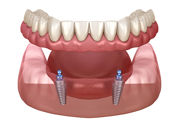 Implant Overdenture Options For Replacing Missing Teeth
