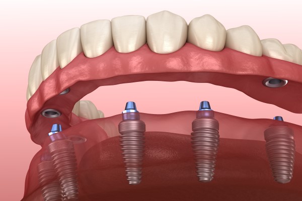 Implant Supported Dentures Red Bluff, CA