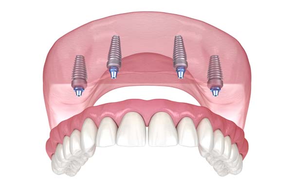 Implant Supported Dentures Red Bluff, CA
