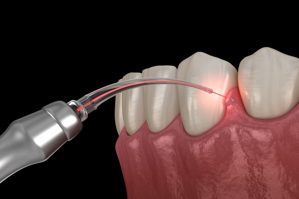 How Laser Dentistry Is Used During A Deep Cleaning