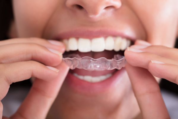 Why A Professionally Made Night Guard Is Better For Bruxism