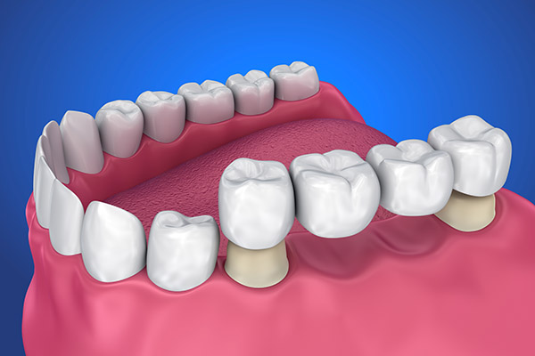 Options for the Replacement of Multiple Missing Teeth from Randal S. Elloway DDS, Inc in Red Bluff, CA