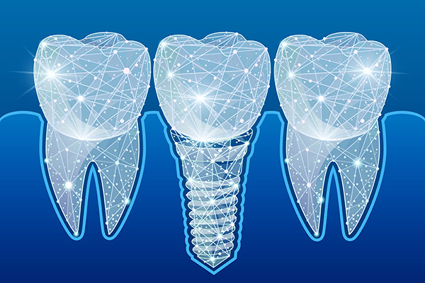 Preventing Complications After Getting Dental Implants from Randal S. Elloway DDS, Inc in Red Bluff, CA
