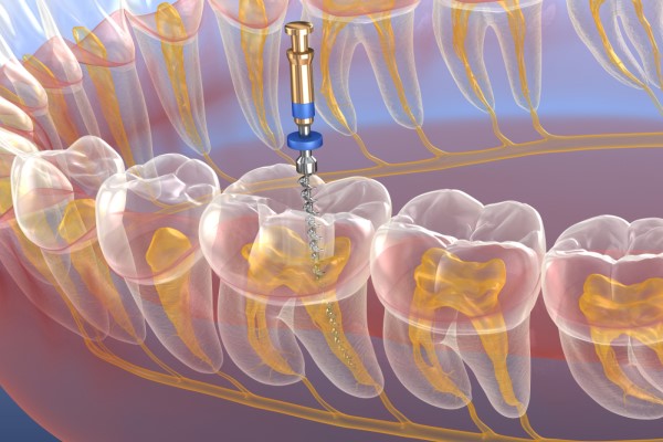 Root Canal Treatment Red Bluff, CA