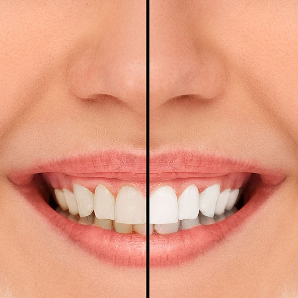 What Is A Full Mouth Reconstruction?