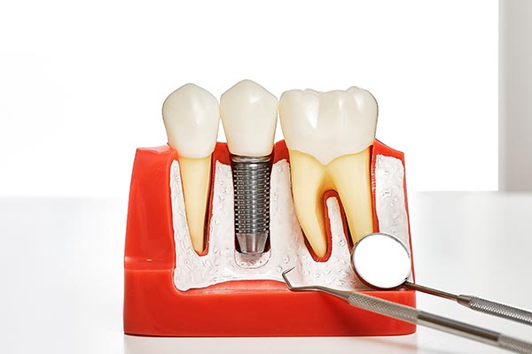 Your Guide to Different Kinds of Dental Implants from Randal S. Elloway DDS, Inc in Red Bluff, CA